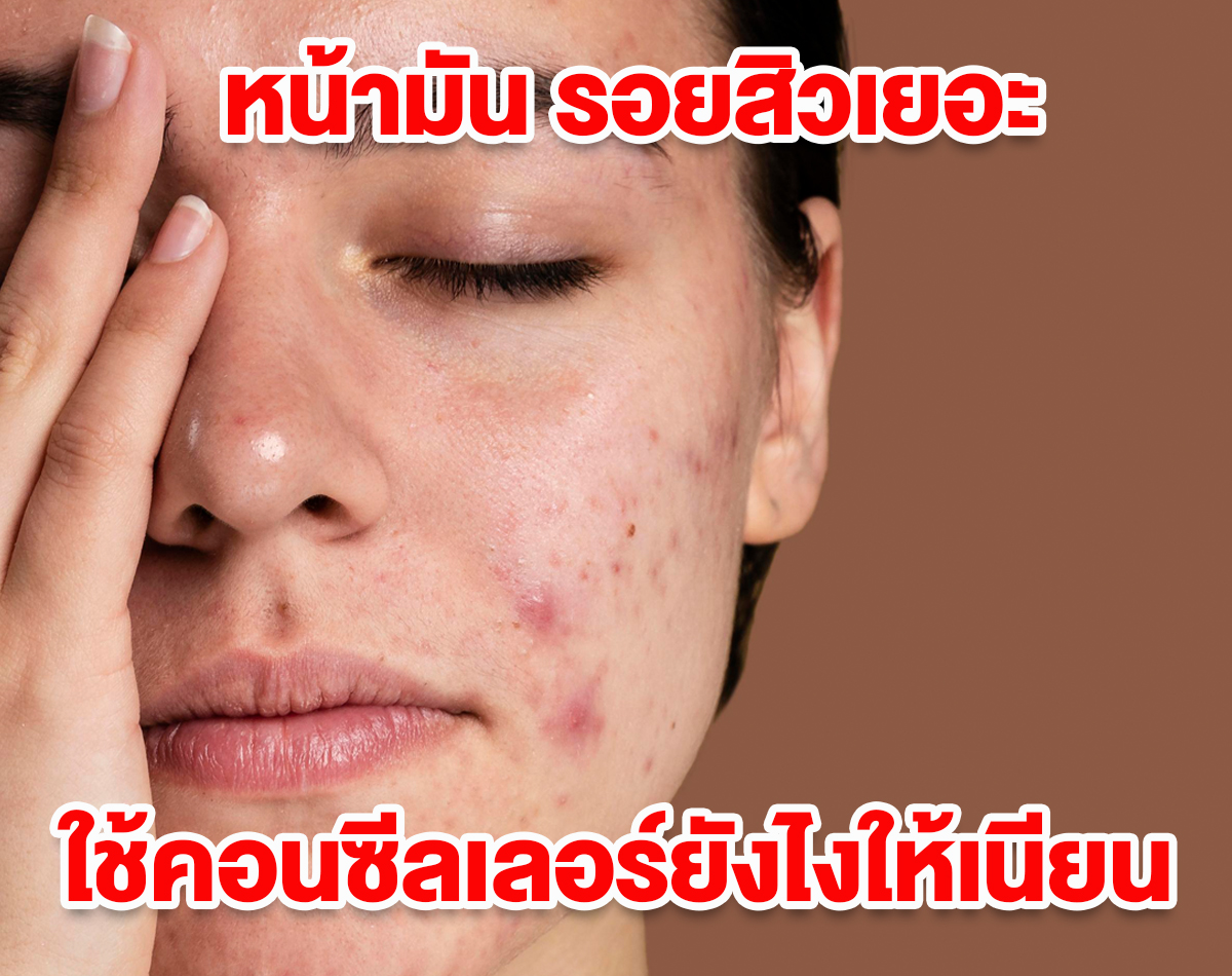 หน้ามัน รอยสิวเยอะ ใช้คอนซีลเลอร์ยังไงให้เนียน 